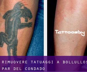 Rimuovere Tatuaggi a Bollullos par del Condado