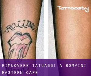 Rimuovere Tatuaggi a Bomvini (Eastern Cape)