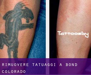 Rimuovere Tatuaggi a Bond (Colorado)