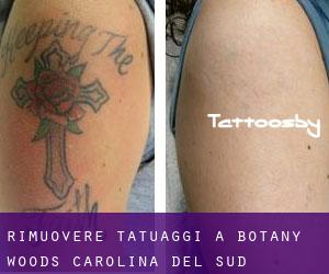 Rimuovere Tatuaggi a Botany Woods (Carolina del Sud)