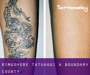 Rimuovere Tatuaggi a Boundary County