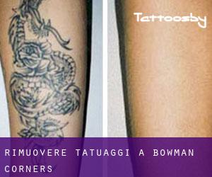 Rimuovere Tatuaggi a Bowman Corners