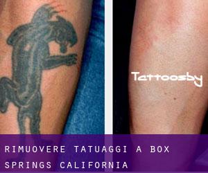 Rimuovere Tatuaggi a Box Springs (California)