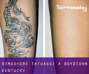 Rimuovere Tatuaggi a Boydtown (Kentucky)