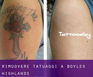 Rimuovere Tatuaggi a Boyles Highlands
