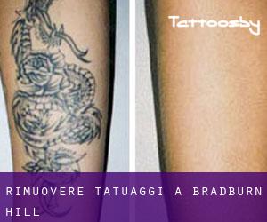 Rimuovere Tatuaggi a Bradburn Hill