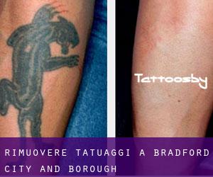 Rimuovere Tatuaggi a Bradford (City and Borough)