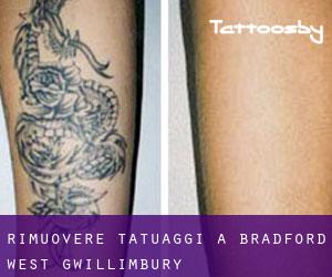 Rimuovere Tatuaggi a Bradford West Gwillimbury