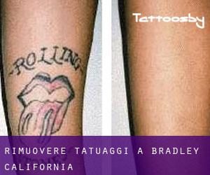 Rimuovere Tatuaggi a Bradley (California)
