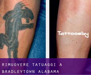 Rimuovere Tatuaggi a Bradleytown (Alabama)
