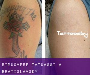 Rimuovere Tatuaggi a Bratislavský
