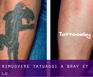 Rimuovere Tatuaggi a Bray-et-Lû
