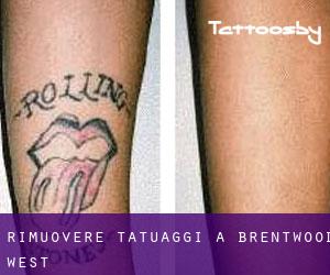 Rimuovere Tatuaggi a Brentwood West