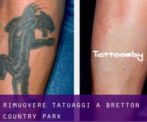 Rimuovere Tatuaggi a Bretton Country Park