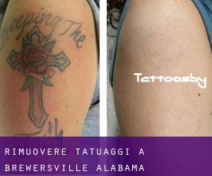 Rimuovere Tatuaggi a Brewersville (Alabama)