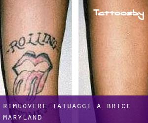 Rimuovere Tatuaggi a Brice (Maryland)