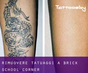 Rimuovere Tatuaggi a Brick School Corner