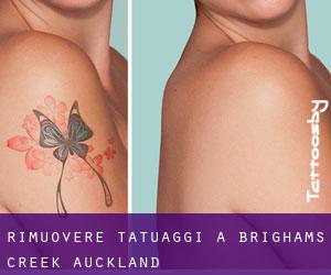 Rimuovere Tatuaggi a Brighams Creek (Auckland)