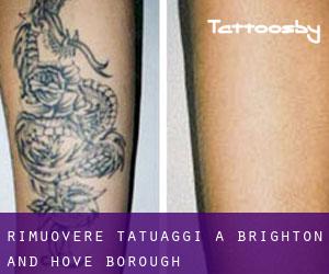 Rimuovere Tatuaggi a Brighton and Hove (Borough)