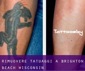 Rimuovere Tatuaggi a Brighton Beach (Wisconsin)