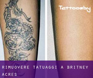 Rimuovere Tatuaggi a Britney Acres