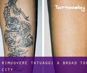 Rimuovere Tatuaggi a Broad Top City