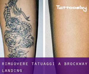 Rimuovere Tatuaggi a Brockway Landing
