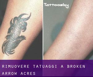 Rimuovere Tatuaggi a Broken Arrow Acres