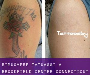 Rimuovere Tatuaggi a Brookfield Center (Connecticut)