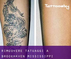 Rimuovere Tatuaggi a Brookhaven (Mississippi)
