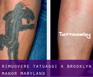 Rimuovere Tatuaggi a Brooklyn Manor (Maryland)