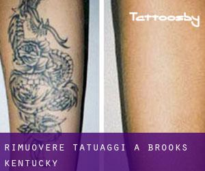 Rimuovere Tatuaggi a Brooks (Kentucky)