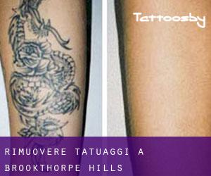 Rimuovere Tatuaggi a Brookthorpe Hills