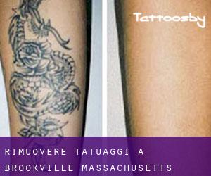 Rimuovere Tatuaggi a Brookville (Massachusetts)