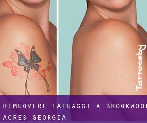 Rimuovere Tatuaggi a Brookwood Acres (Georgia)