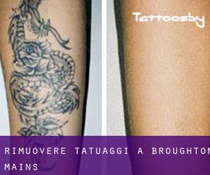 Rimuovere Tatuaggi a Broughton Mains