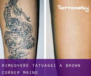 Rimuovere Tatuaggi a Brown Corner (Maine)