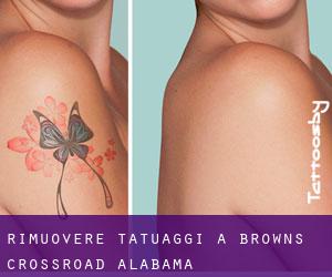 Rimuovere Tatuaggi a Browns Crossroad (Alabama)