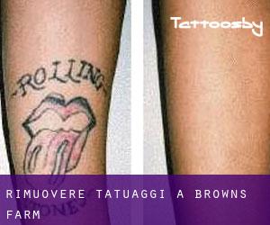 Rimuovere Tatuaggi a Browns Farm