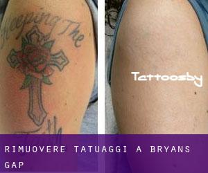 Rimuovere Tatuaggi a Bryans Gap