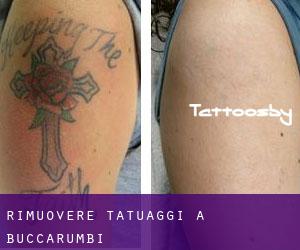 Rimuovere Tatuaggi a Buccarumbi