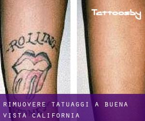 Rimuovere Tatuaggi a Buena Vista (California)