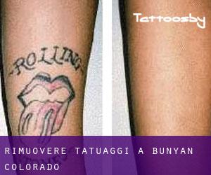 Rimuovere Tatuaggi a Bunyan (Colorado)