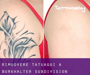 Rimuovere Tatuaggi a Burkhalter Subdivision