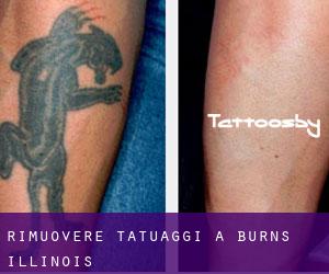 Rimuovere Tatuaggi a Burns (Illinois)