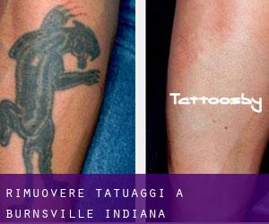 Rimuovere Tatuaggi a Burnsville (Indiana)