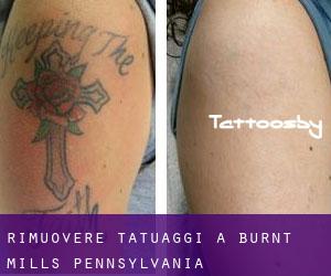 Rimuovere Tatuaggi a Burnt Mills (Pennsylvania)
