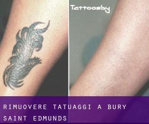 Rimuovere Tatuaggi a Bury Saint Edmunds