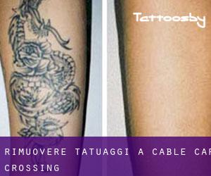 Rimuovere Tatuaggi a Cable Car Crossing