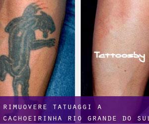 Rimuovere Tatuaggi a Cachoeirinha (Rio Grande do Sul)